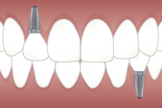 9 Myths About California Dental Implants that Hold Patients Back